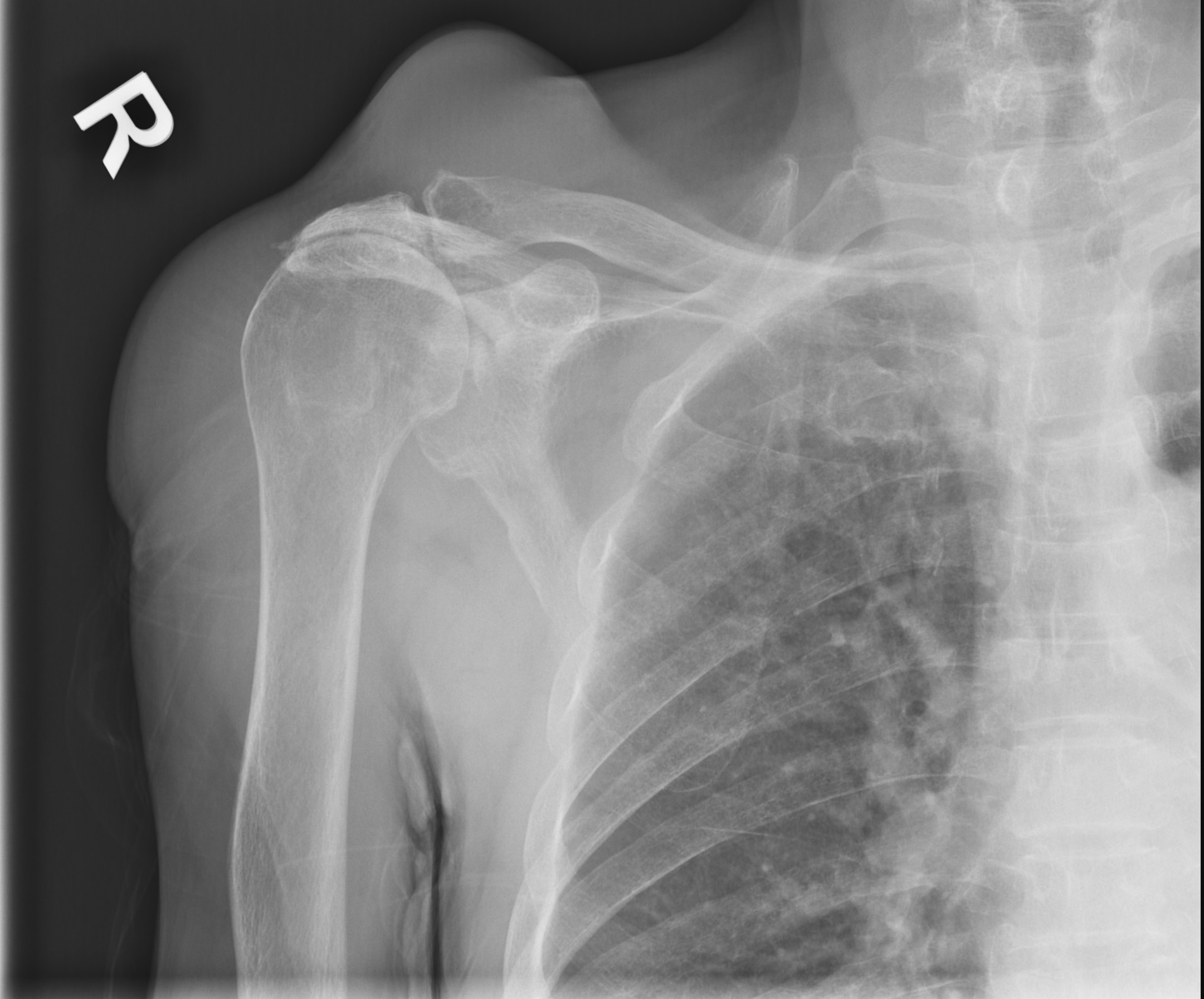 Frontal right shoulder radiograph